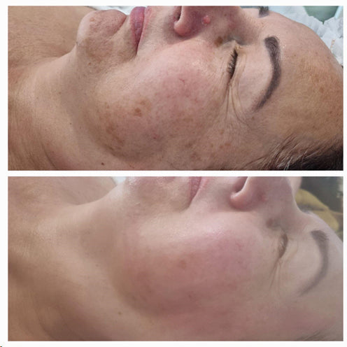 4-Wochen Wunderset bei Pigmentflecken und -störungen