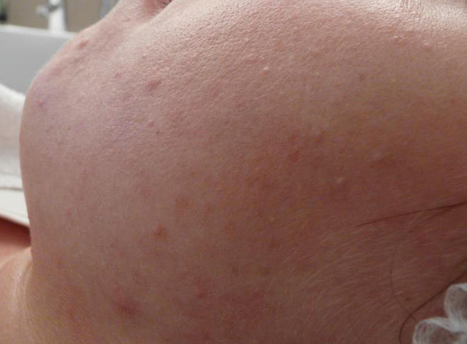 4-Wochen Wunderset bei Akne und unreiner Haut