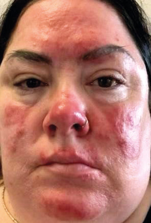 4-Wochen Wunderset bei nervöser, geröteter Haut und Rosazea